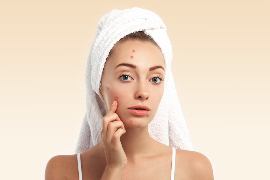 acne scare treatment in sonipat