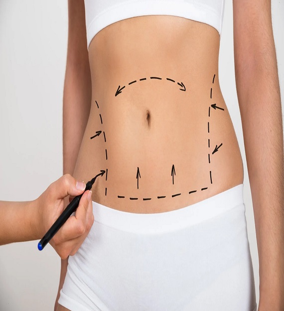 best liposuction doctor in Sonipat